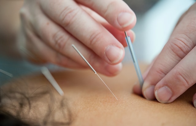 Picture of a person with acupuncture needles on his body 