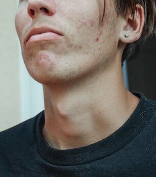 picture of a person with blemishes 