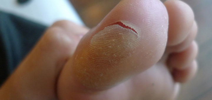 Picture of a blister