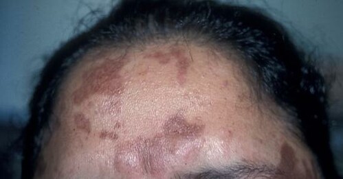Picture of skin with pigmentation 