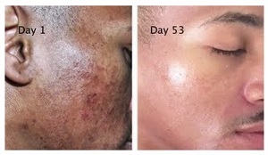 Picture of hyperpigmentation-before-and-after