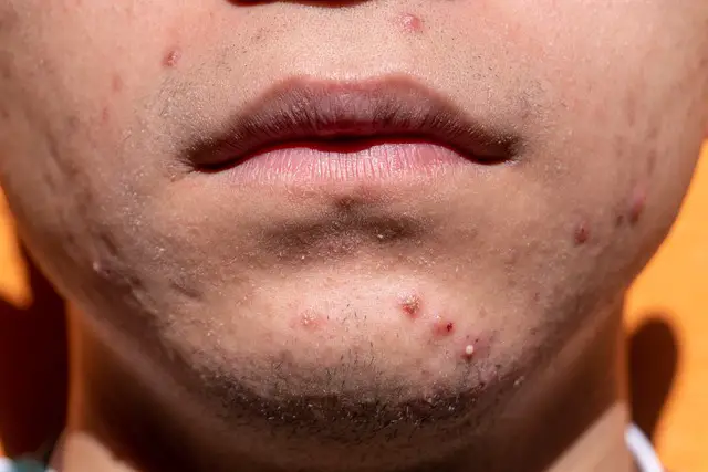 Picture of a persons face with ACNE