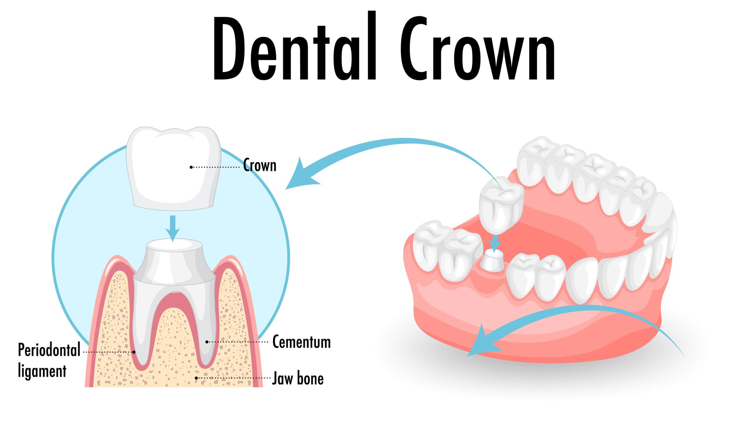 picture of dental crown procedure 