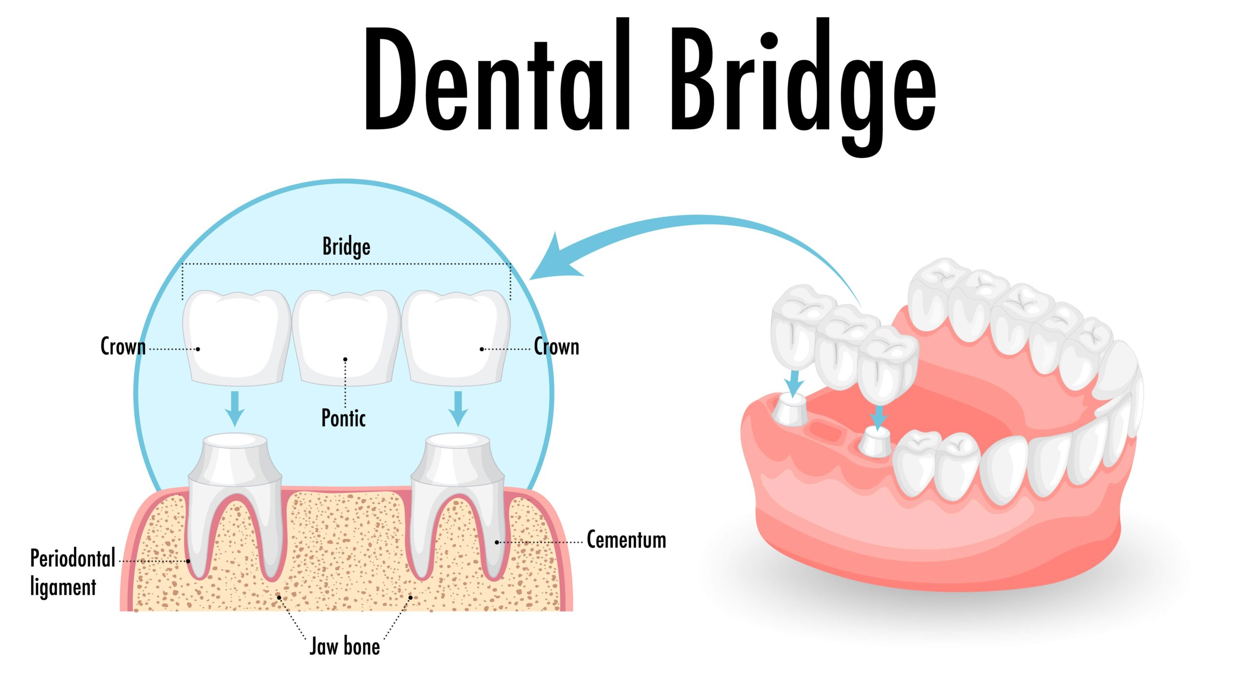 picture of dental bridge procedure 