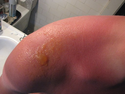 picture of a sunburn blister