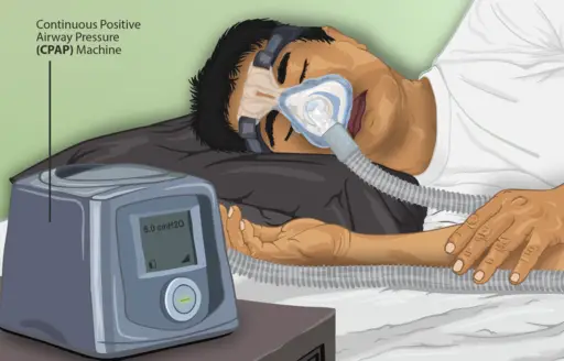 Picture of a Sleep Apnea patient using a CPAP machine